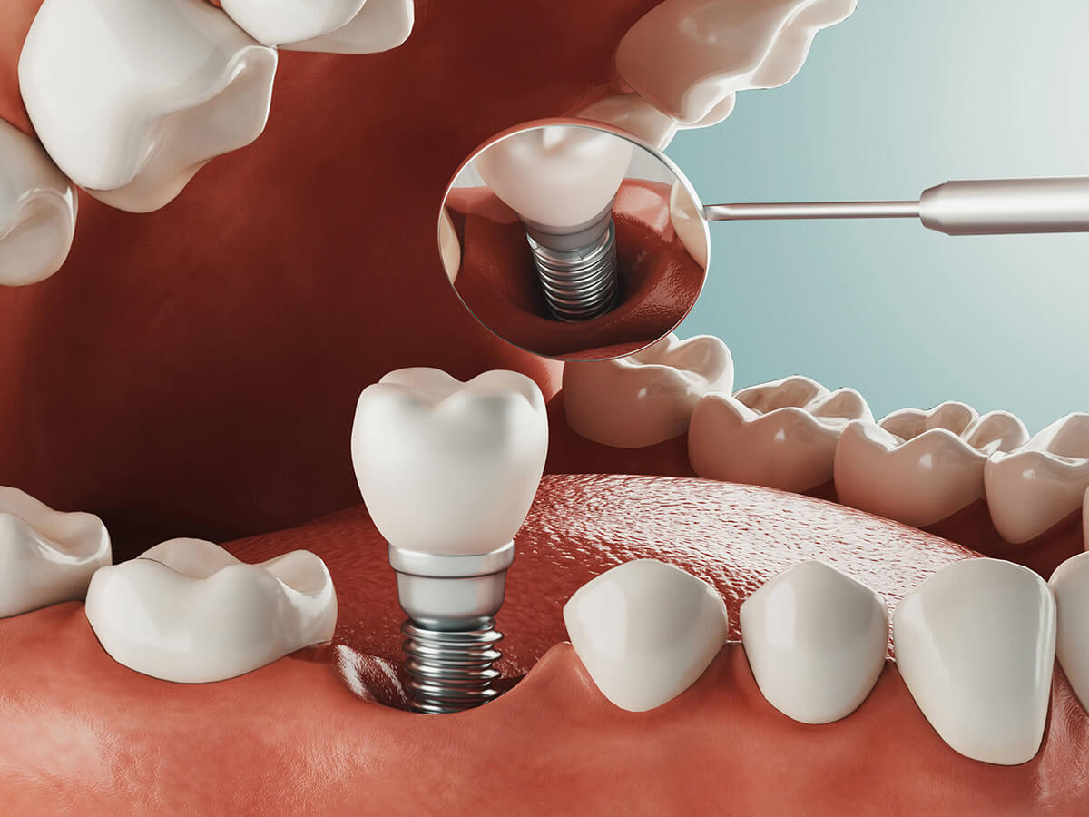 Dental Implants Dentist DeFuniak Springs, FL DeFuniak Springs