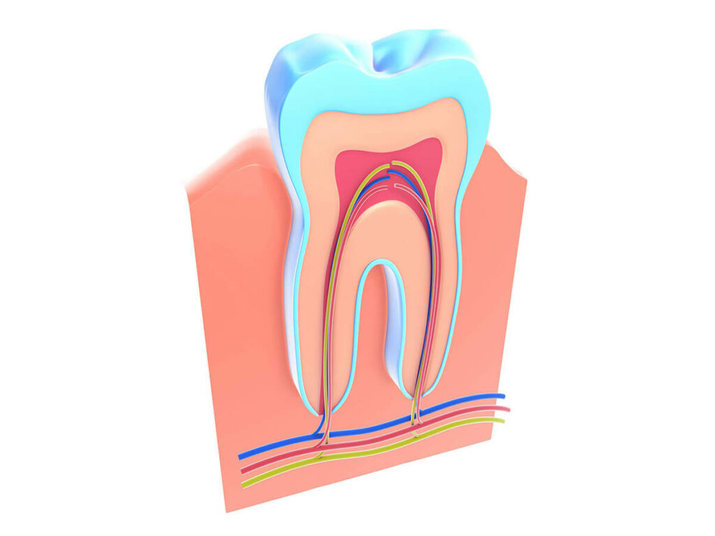 an illustration of a tooth in need of a root canal
