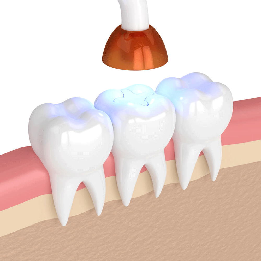 an illustration of a tooth getting a cavity filling