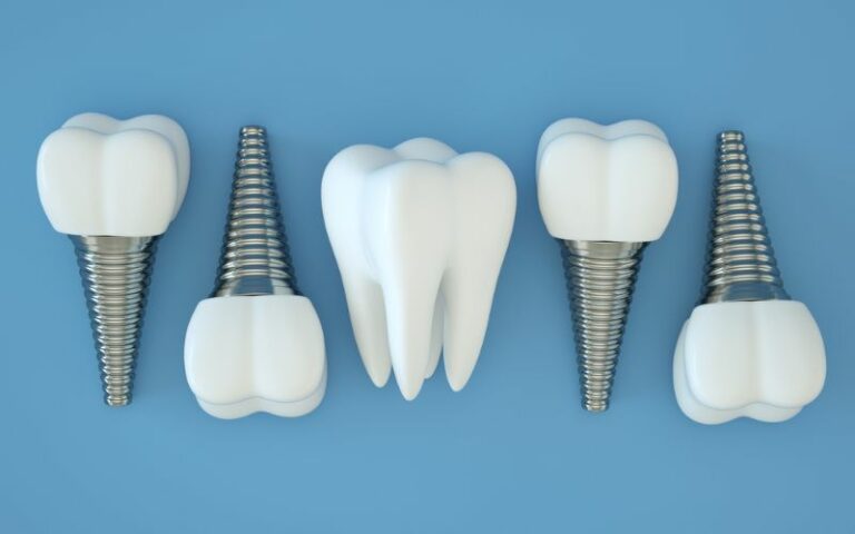 dental implants illustraton