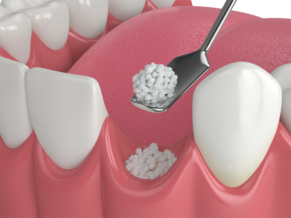 a dental bone grafting illustration