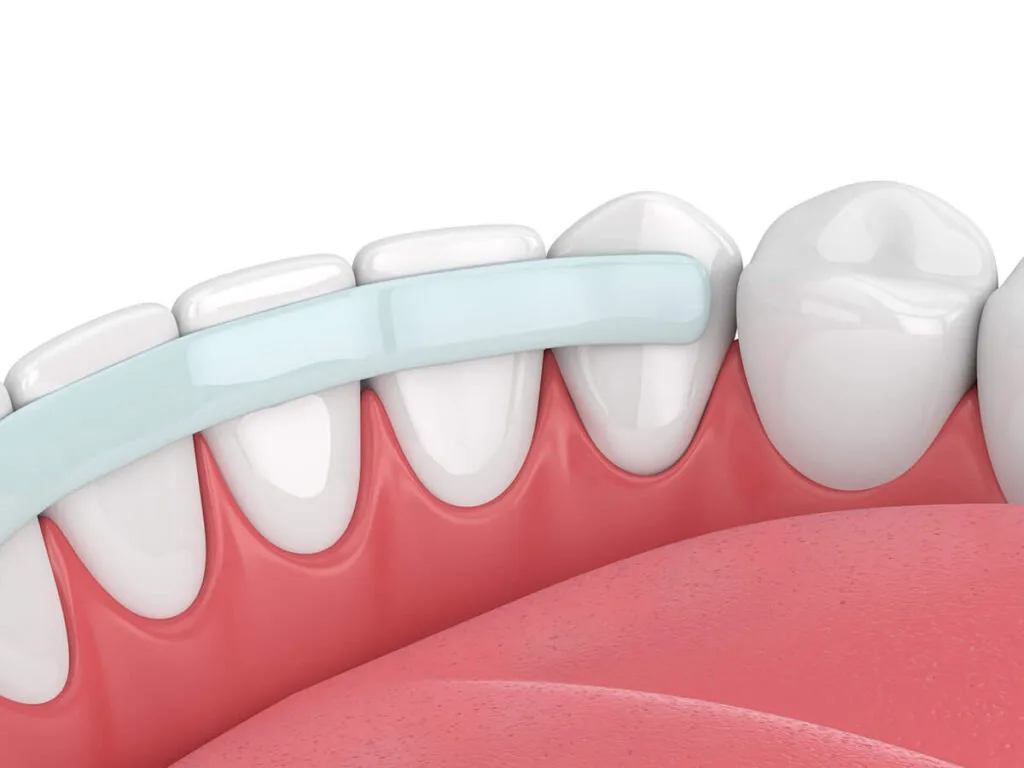 an illustration of teeth with dental bonding at DeFuniak Springs Family Dental