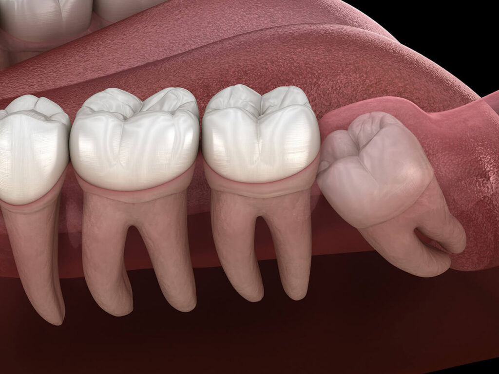 an illustration of a widsom tooth crowding into other molars, needing wisdom teeth extraction